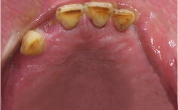 上颌多颗牙种植修复[治疗前]