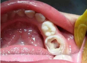牙髓病治疗前的注意事项