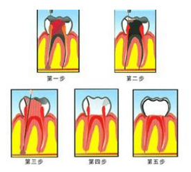 牙髓炎的症状有哪些