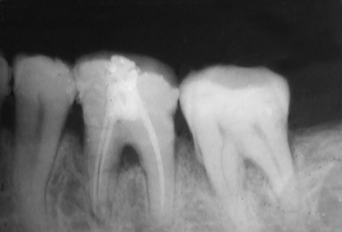 引起牙周萎缩的原因以及治疗方法