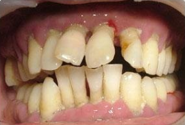 牙周脓肿应该怎么治疗呢
