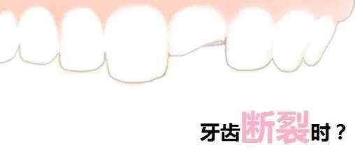 牙齿裂开如何修复