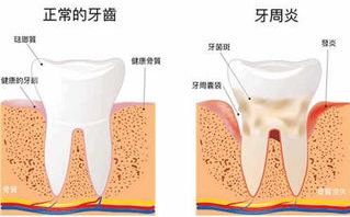 牙龈炎和牙周炎有什么区别吗