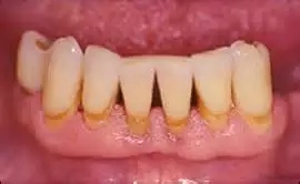 牙龈萎缩怎么回事
