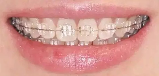牙齿矫正的危害